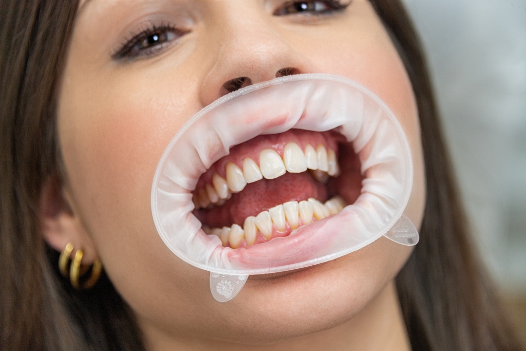 OptraGate pour Scanner taille "Petite" (copie)